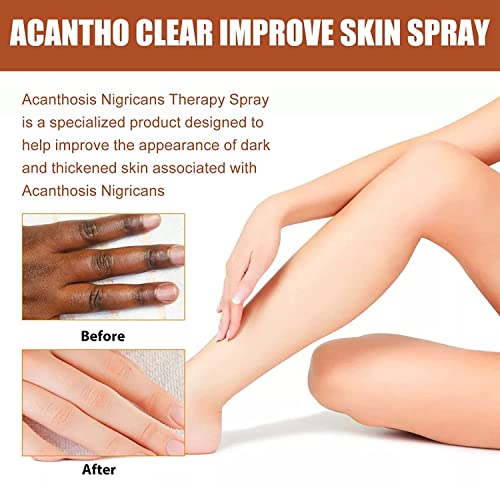 Acantho Clear Terapy Spray, Acanthosis Nigricans terapia Óleo, Body Body CORPO DEGA NIGRICARE TERAPIO