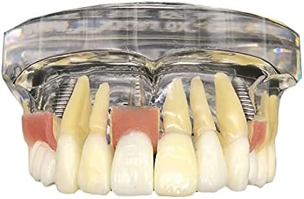 KH66ZKY MAXILARY IMPLATA ESTUDO DE IMPLUSA DS demonstração Modelo de dentes - Modelo de implante dentário - com dentes removíveis
