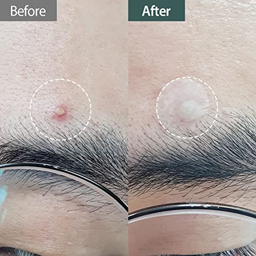 Dashu A.C Cica Spot Patch 51patches - Tampa de absorção de espinhas acne, mancha, tratamento de ponto